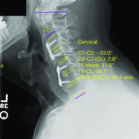 Pre Operative Cervical Spine X Ray With Radiographic Measurements