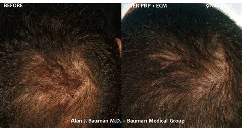 36 y/o Male PRP w/ECM Hair Regrowth Results · Bauman Medical Group