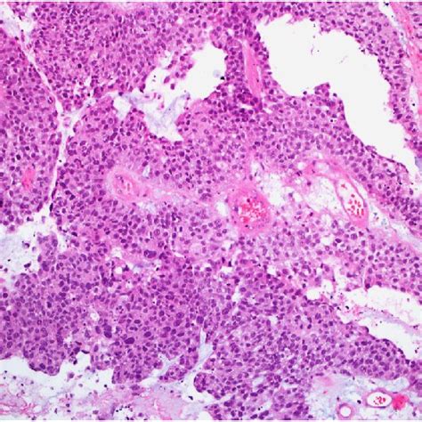 Gata 3 Of The Right Inguinal Lymph Node Showing Positive Nuclear Download Scientific Diagram