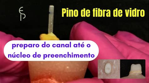 Passo A Passo Pino De Fibra De Vidro - Pino de Fibra de Vidro Passo a Passo | Preparo, Cimentação e Núcleo com ...