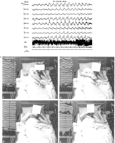 Figure 2 from Autosomal dominant nocturnal frontal lobe epilepsy. A distinctive clinical ...