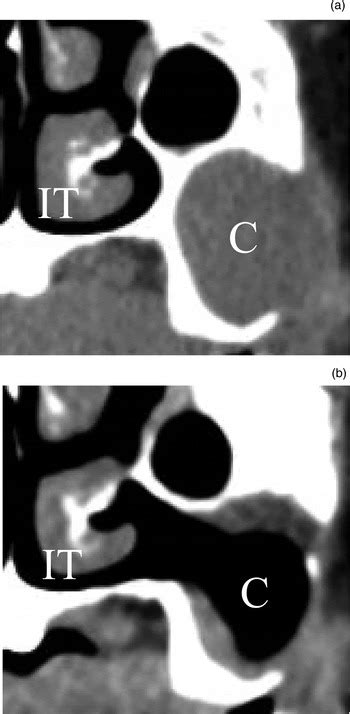 Transnasal inferior meatal antrostomy with a mucosal flap for post-Caldwell–Luc mucoceles in the ...