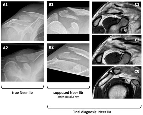 Clavicle Fracture Classification