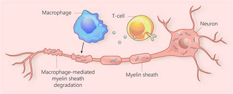 Multiple Sclerosis Pathophysiology Diagram