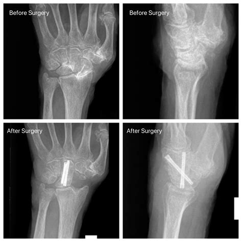 SLAC wrist arthritis - John Erickson, MD