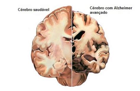 Mal De Alzheimer O Que é Sintomas Tratamento Causas E Mais