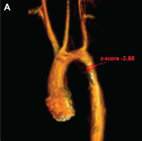 Cardiac MRA Aortic Arch Angiography And Hemodynamic Waveforms Before