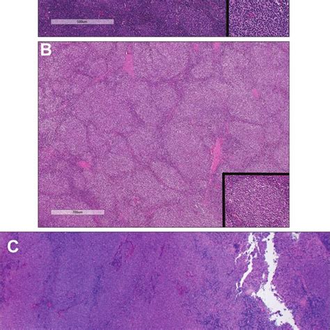 Histology of follicular lymphoma. The WHO Classification utilizes a ...