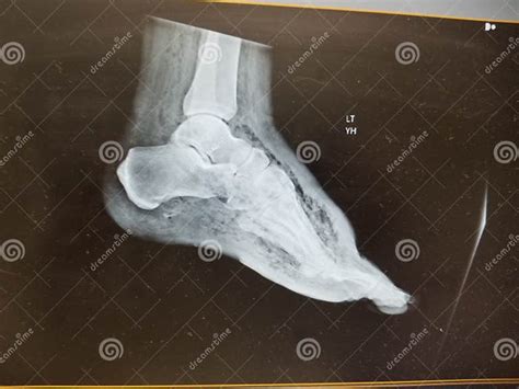 Foot Xray Showing Soft Tissue Gas In Patient With Necrotizing