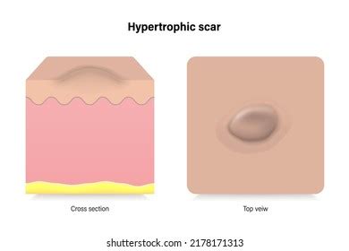 Hypertrophic Scars Facial Skin Problems Vector Stock Vector (Royalty ...