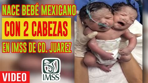 Nace bebé con 2 cabezas en IMSS de Cd Juarez Chihuahua Video YouTube