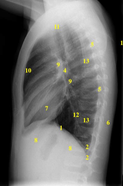 Lateral Chest X Ray Labeled