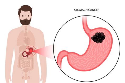 Understanding Stomach Cancer Causes Symptoms And Treatments Dania