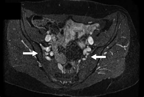 Pelvic Venous Insufficiency Imaging Diagnosis Treatment Approaches