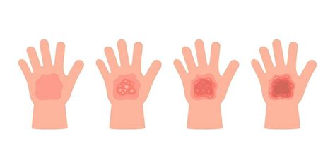 Burn of hand child skin different degree. First aid for fire or chemical injury skin. Visual ...