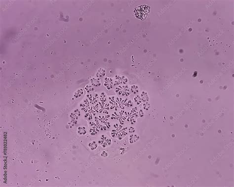 Microscopic Fungi Malassezia Furfur Showing Yeast Cells And Hyphae Dermatophytes Nail