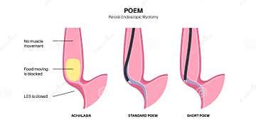 POEM medical poster stock vector. Illustration of achalasia - 290866837