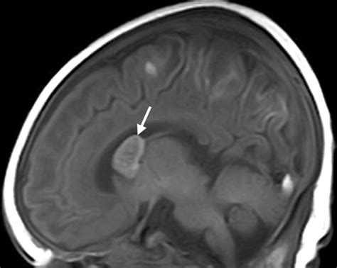 Differential Diagnosis Of Intracranial Cystic Lesions At Head Us