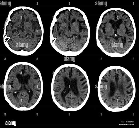 Alzheimers Disease Brain Ct Scan