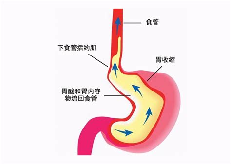 胃食管反流怎么办药物治疗有哪些该注意哪些饮食情况 腾讯新闻