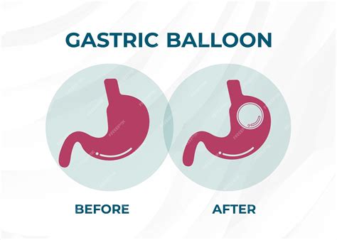 Balão gástrico de endoscopia de estômago dentro de uma cirurgia de ...