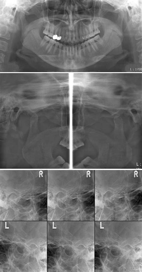 Panoramic A Temporomandibular Joint Panoramic B And Transcranial