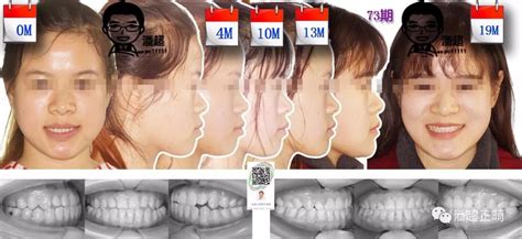 73期，20岁骨性地包天，磨牙反牙合，高角，拔牙矫正