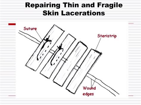 Bud S Common And Simples Superficial Laceration Repair Of Thin And Fragile Skin — Downeast