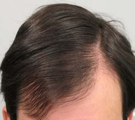 Mens Hair Loss Treatment Dr Health Clinic Homepage