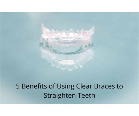 Benefits Of Using Clear Braces