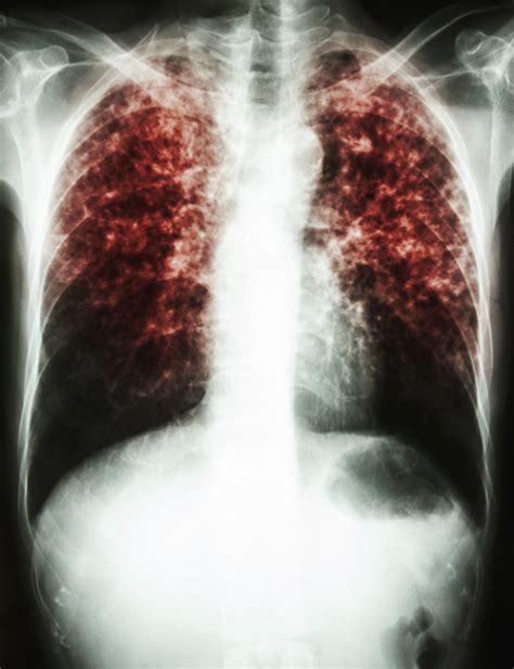 Tuberculosis Treatments — Pai Life Sciences