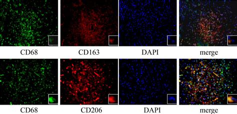 Immunofluorescence Staining Of Hcc Tissues The Expression Of Cd68 Download Scientific Diagram