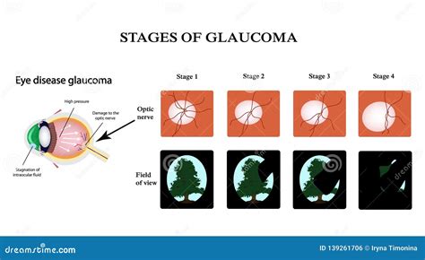 Glaucoma. The Field Of Vision In Glaucoma. Infographics. Vector Stock ...