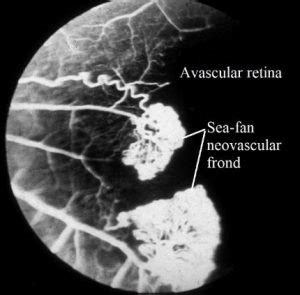 Sickle Cell Retinopathy Sea Fan