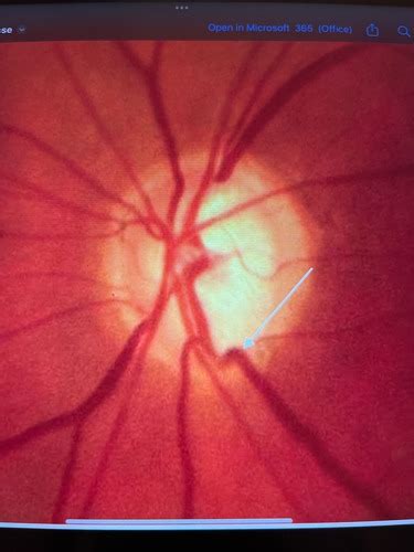 Differential ONH disease - ICHT, Papilloedema, papillitis, optic ...