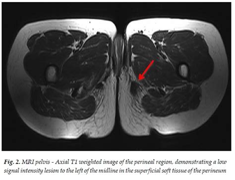 A Tale Of Two Sit Bones The Cyclists Ischial Hygroma Perineal