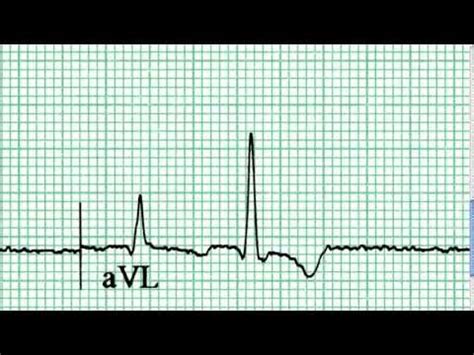 Interpretacja Ekg Pierwsze Wra Enia Film Medtube Pl