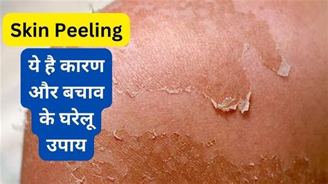 जानें क्या होती है Skin Peeling गर्मियों में बचाव के ये है तरीके Know What Is Skin Peeling