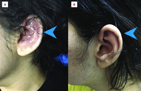 Perichondritis