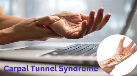 Carpal Tunnel Syndrome Diagnosis And Treatment Youtube