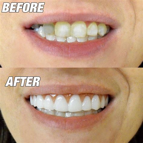 How Veneers Can Fix Your Teeth