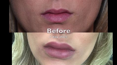 Juvederm Lips Before And After Half Syringe