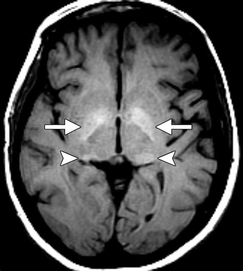 Intracranial Lesions With High Signal Intensity On T1 Weighted MR