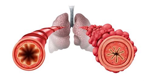 Vaping And Popcorn Lung Medicine