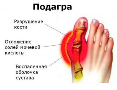Болят суставы пальцев на ногах: причины и лечение