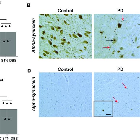 Quantitation Of Alpha Synuclein Pathology In The Substantia Nigra Sn