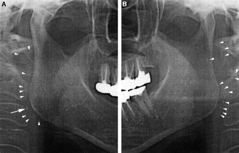 Multiple Sialolithiasis In The Parotid Gland With Sjögrens Syndrome