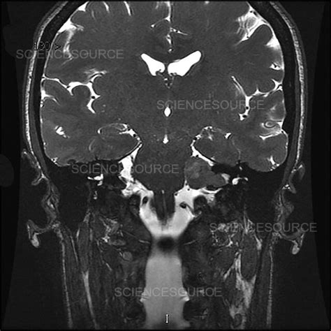 Vestibular Schwannoma, MRI | Stock Image - Science Source Images