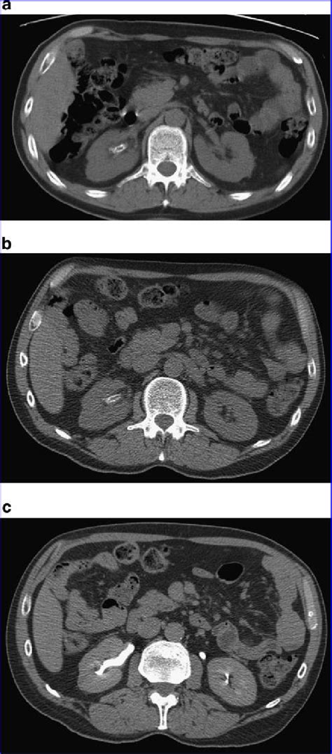 A Patient 1 Noncontrast Ct At Presentation Showing Calcification Of