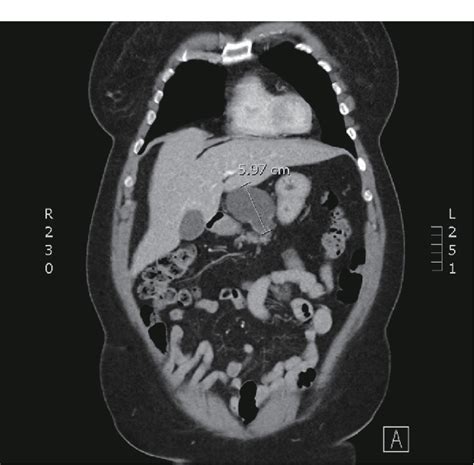 Figure 1 From Pancreatic Cystic Lymphangioma Case Report And